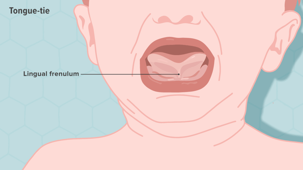 Tongue And Lip Ties What Should I Know — Champions Pediatric Dentistry